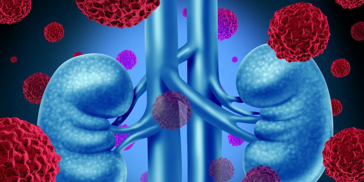 Нефрэктомия, лучевая терапия, химиотерапия и другие методы лечения почечно-клеточного рака